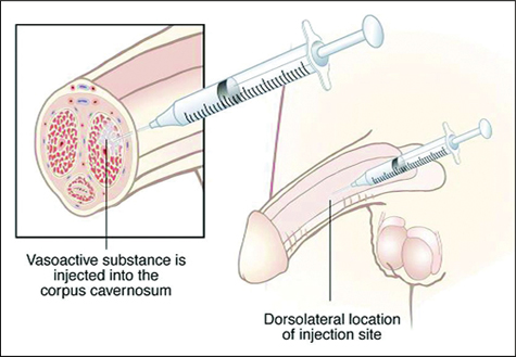 Injection spot for steroids